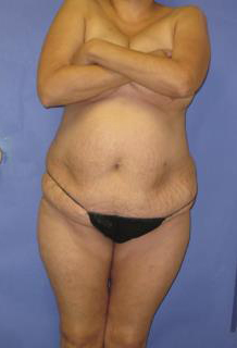 VASER Liposuction Before & After Patient #341