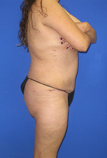 VASER Liposuction Before & After Patient #341