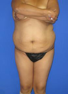 VASER Liposuction Before & After Patient #362