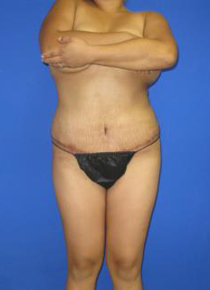 VASER Liposuction Before & After Patient #362