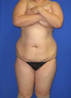 Avelar Tummy Tuck Before & After Patient #373