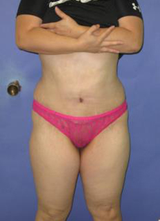 Avelar Tummy Tuck Before & After Patient #373