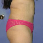 Avelar Tummy Tuck Before & After Patient #373