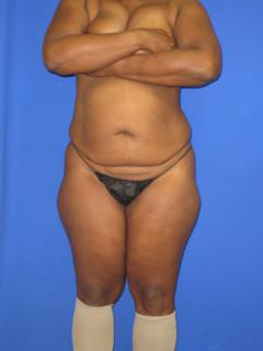 Liposuction Before & After Patient #405