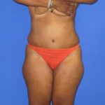 Liposuction Before & After Patient #405