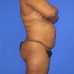 Liposuction Before & After Patient #405