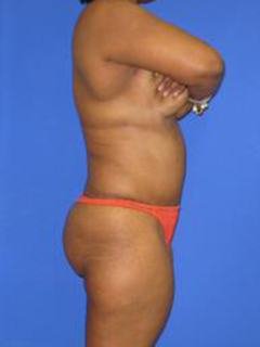 Liposuction Before & After Patient #405