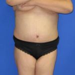 Avelar Tummy Tuck Before & After Patient #394