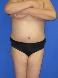 Avelar Tummy Tuck Before & After Patient #394