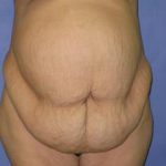 Tummy Tuck Before & After Patient #414