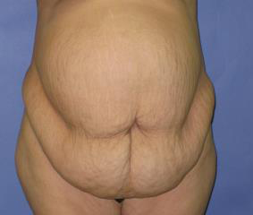 Tummy Tuck Before & After Patient #414