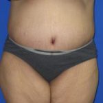 Tummy Tuck Before & After Patient #414