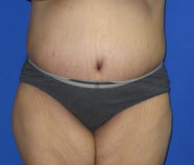 Tummy Tuck Before & After Patient #414