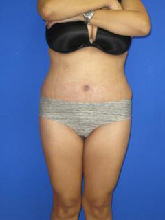 Avelar Tummy Tuck Before & After Patient #428