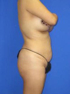 Avelar Tummy Tuck Before & After Patient #428