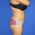 Avelar Tummy Tuck Before & After Patient #428