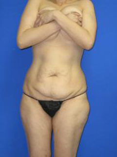 VASER Liposuction Before & After Patient #438