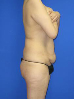 VASER Liposuction Before & After Patient #438