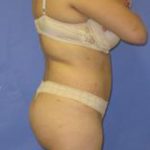 VASER Liposuction Before & After Patient #448