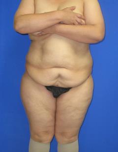 Liposuction Before & After Patient #509