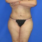 Liposuction Before & After Patient #509