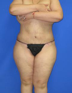 Liposuction Before & After Patient #509