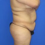 Liposuction Before & After Patient #509