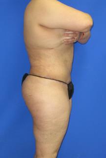 Liposuction Before & After Patient #509