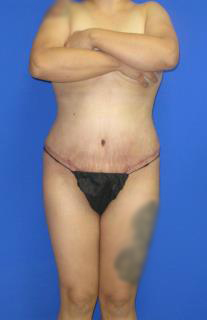 VASER Liposuction Before & After Patient #458