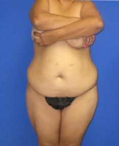 Avelar Tummy Tuck Before & After Patient #527