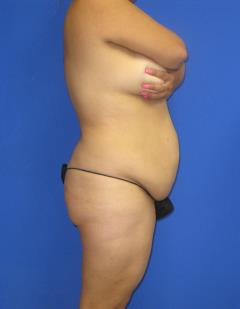 Avelar Tummy Tuck Before & After Patient #527
