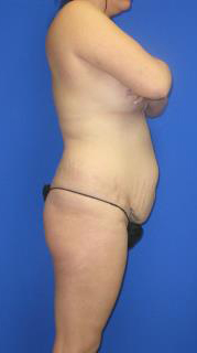 Liposuction Before & After Patient #492