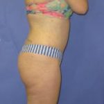 Liposuction Before & After Patient #492