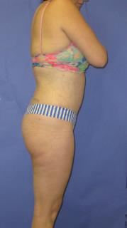 Liposuction Before & After Patient #492