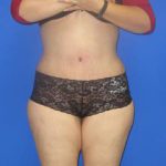 Avelar Tummy Tuck Before & After Patient #518