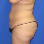 Avelar Tummy Tuck Before & After Patient #518