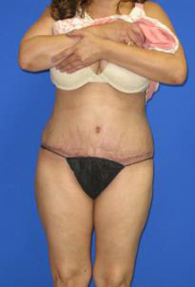 Avelar Tummy Tuck Before & After Patient #553