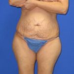 Avelar Tummy Tuck Before & After Patient #553