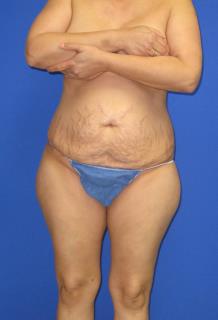 Avelar Tummy Tuck Before & After Patient #553