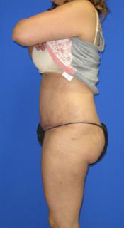 Avelar Tummy Tuck Before & After Patient #553