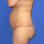 Avelar Tummy Tuck Before & After Patient #553