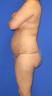 Avelar Tummy Tuck Before & After Patient #553