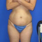 Avelar Tummy Tuck Before & After Patient #547