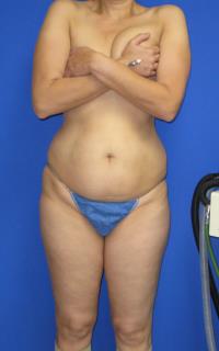 Avelar Tummy Tuck Before & After Patient #547