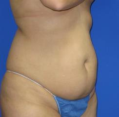 Avelar Tummy Tuck Before & After Patient #547