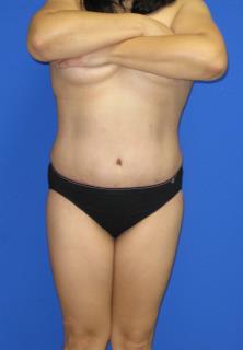 Avelar Tummy Tuck Before & After Patient #603