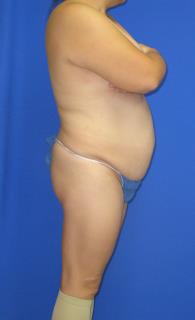 Avelar Tummy Tuck Before & After Patient #603