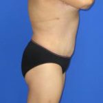 Avelar Tummy Tuck Before & After Patient #603