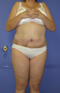 Avelar Tummy Tuck Before & After Patient #569