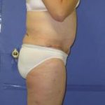 Avelar Tummy Tuck Before & After Patient #569